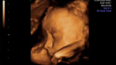 Nevar būt &ldquo;drusku pret abortiem&rdquo;. Un tam nav sakara ar reliģiju